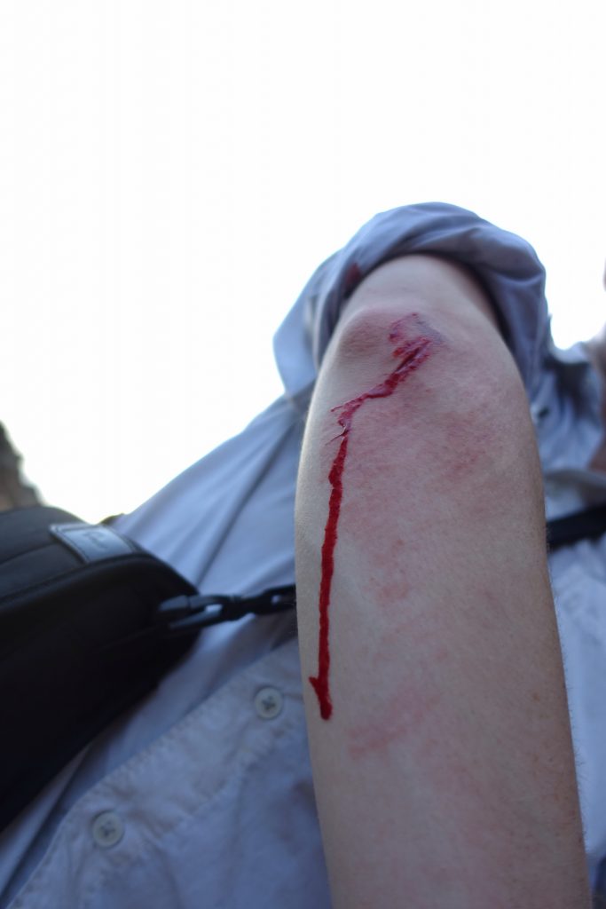 Grazed elbow